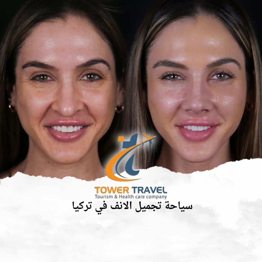 سياحة تجميل الانف في تركيا