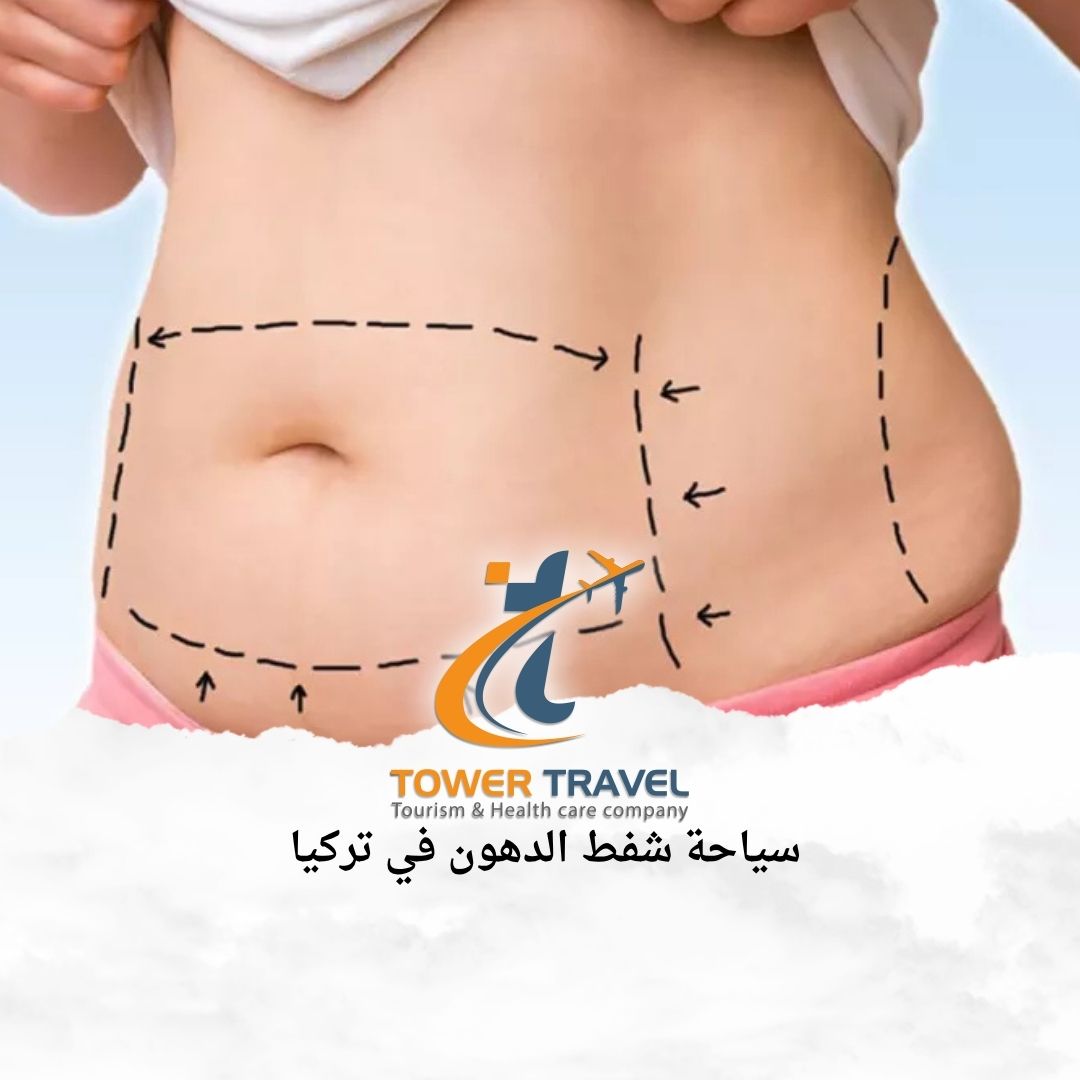 سياحة شفط الدهون في تركيا