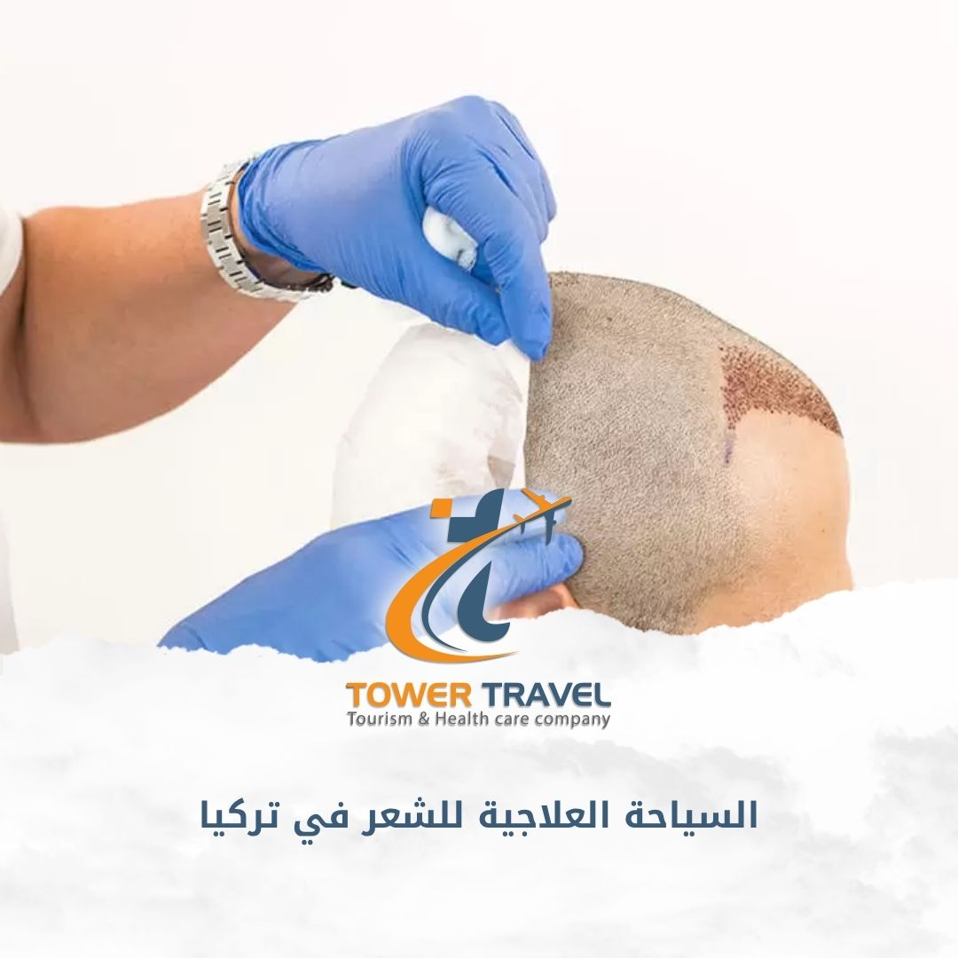 السياحة العلاجية للشعر في تركيا