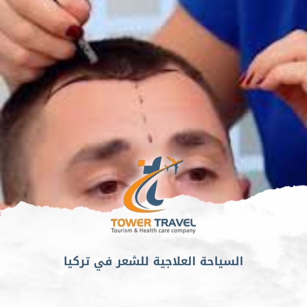 السياحة العلاجية للشعر في تركيا