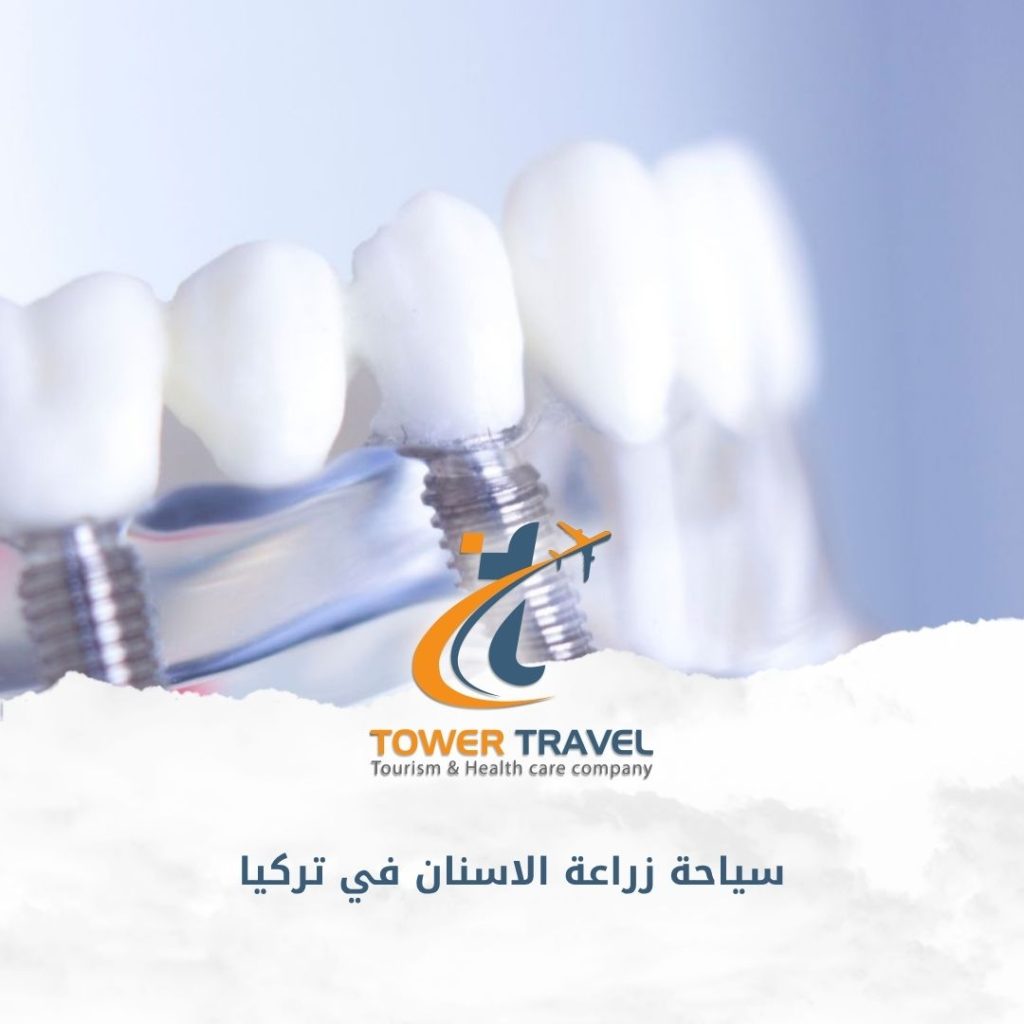سياحة زراعة الاسنان في تركيا