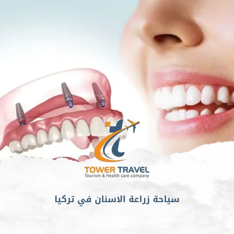 سياحة زراعة الاسنان في تركيا