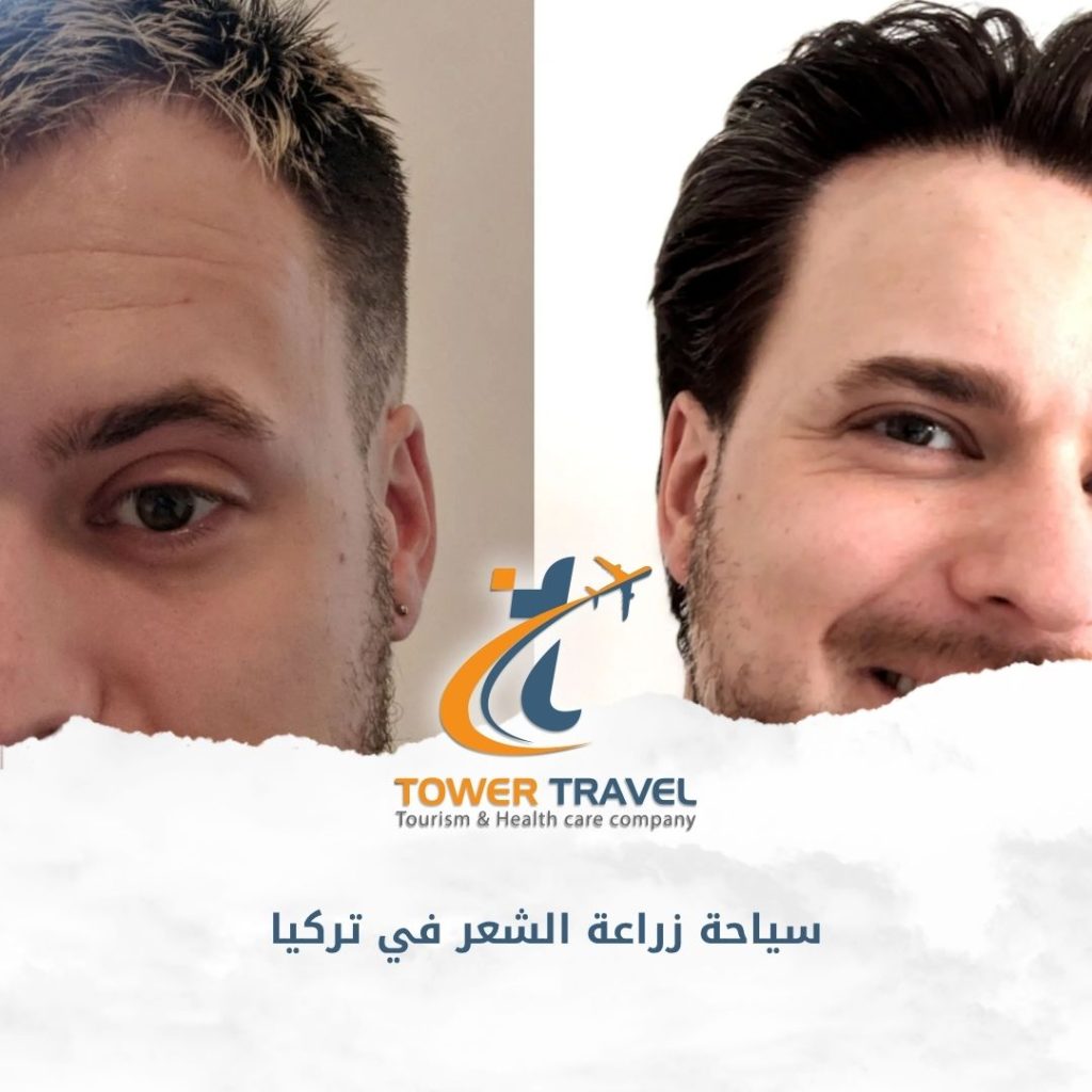 سياحة زراعة الشعر في تركيا