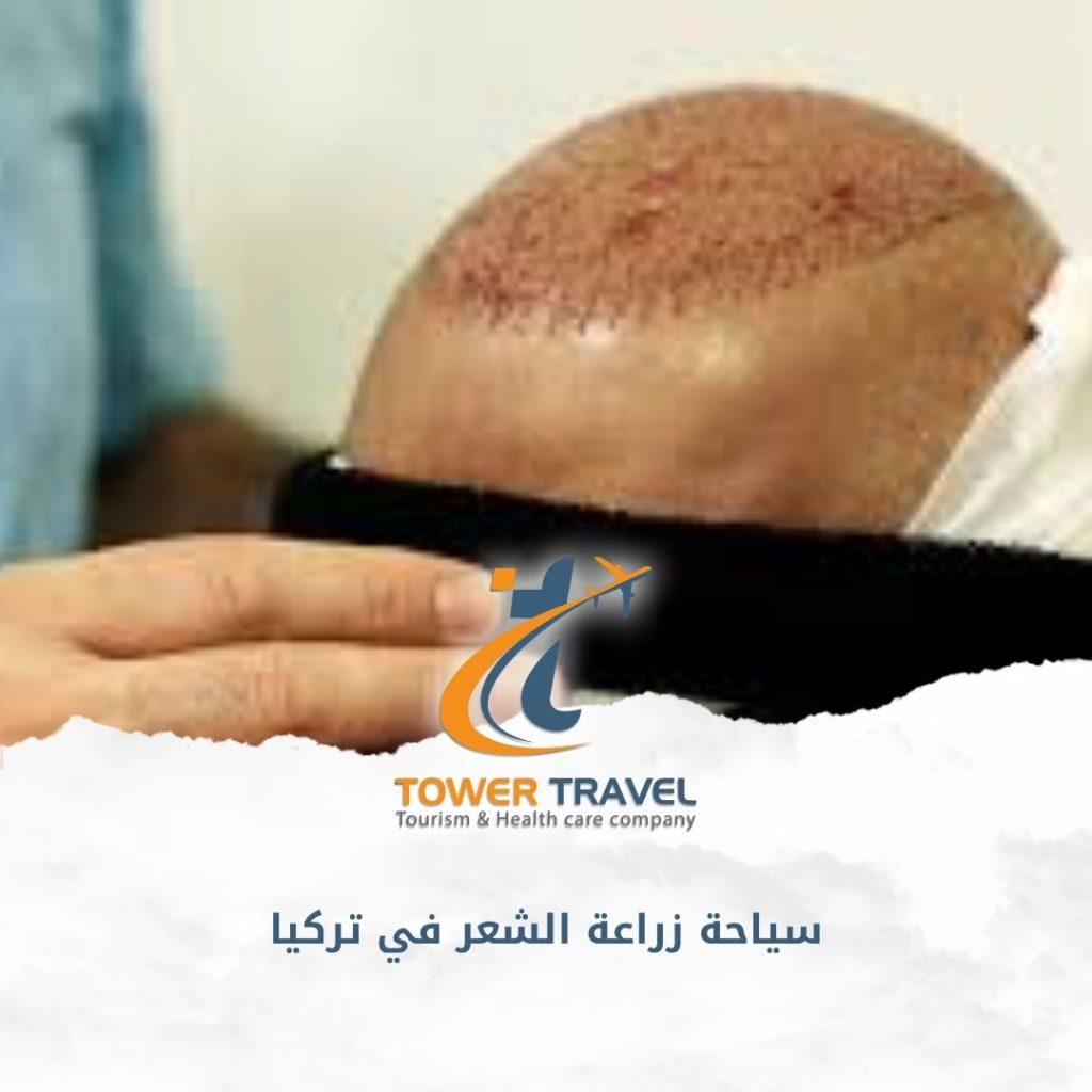 سياحة زراعة الشعر في تركيا