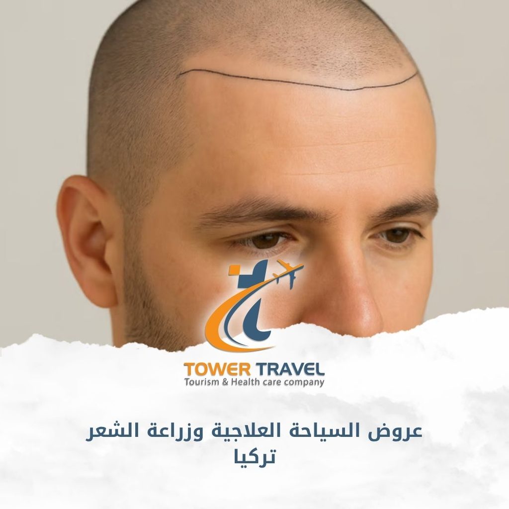 عروض السياحة العلاجية وزراعة الشعر تركيا