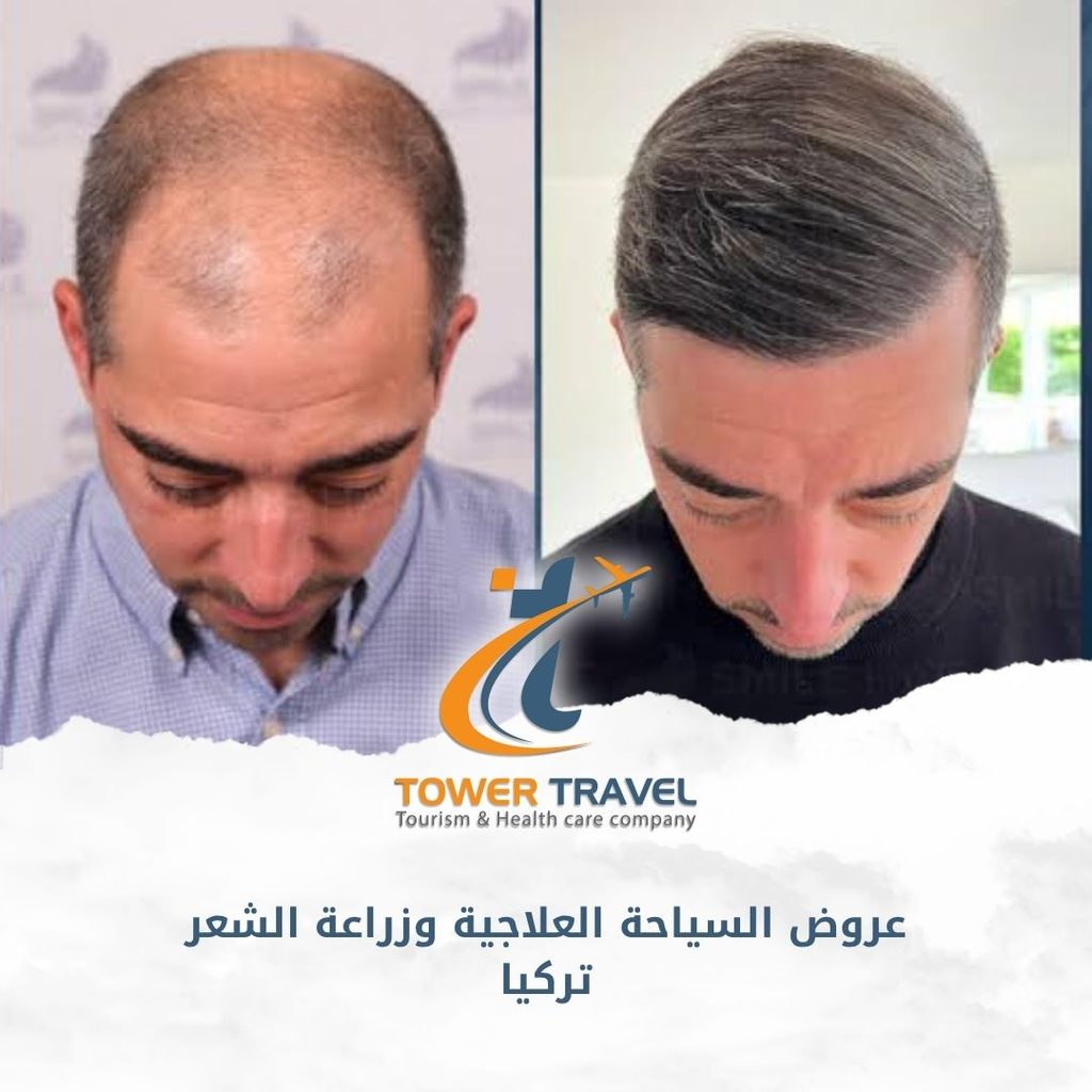 عروض السياحة العلاجية وزراعة الشعر تركيا
